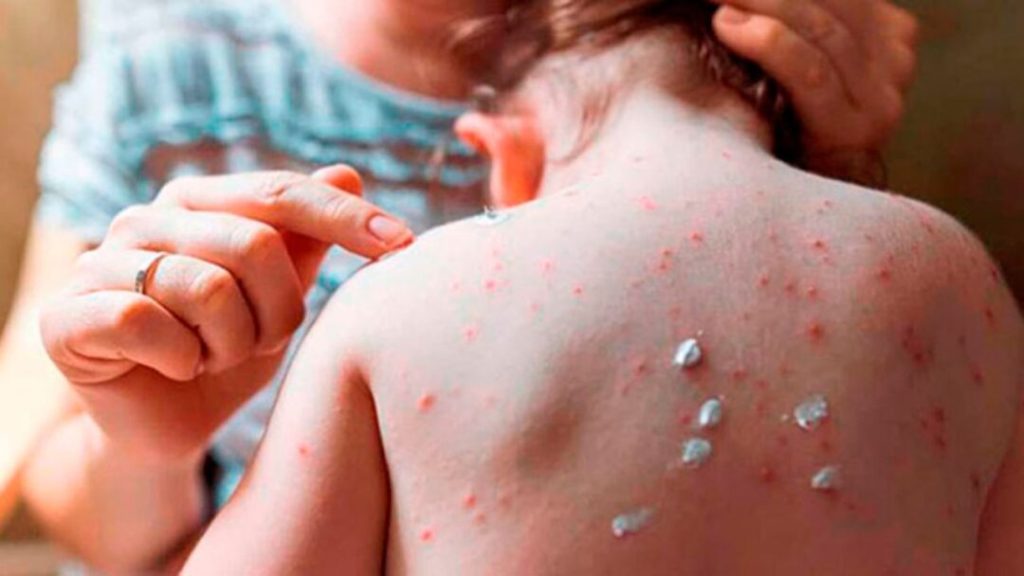 Familia bajo observación por sospecha de viruela del mono en Lempira