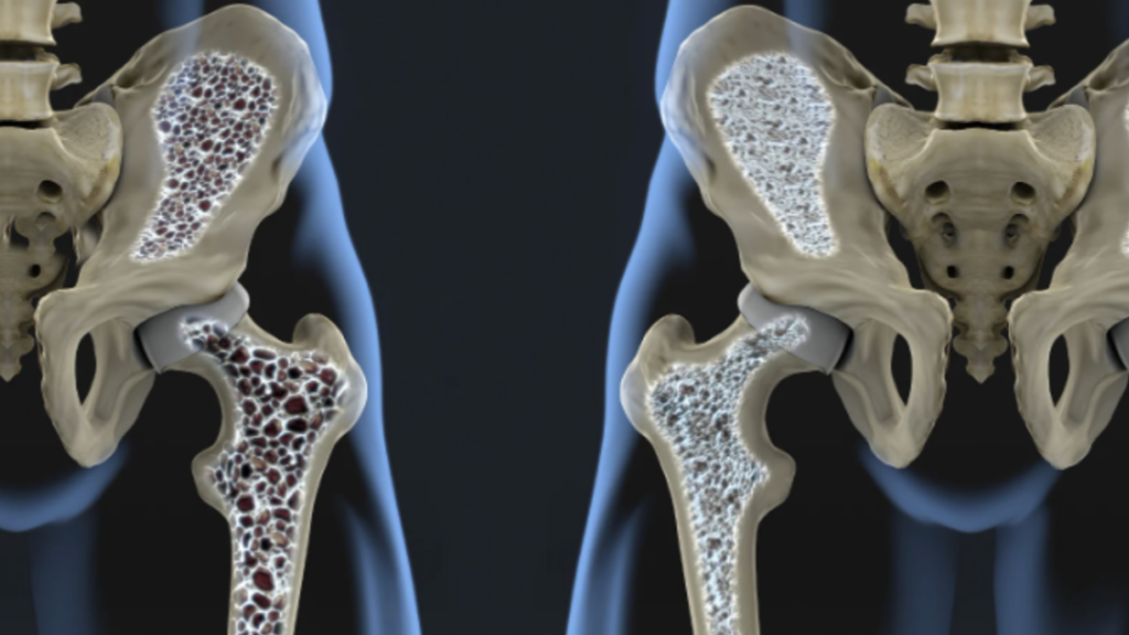 Prevención de osteoporosis