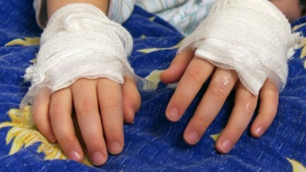 Honduras: 10 niños entre los 14 quemados por pólvora en Nochebuena y Navidad