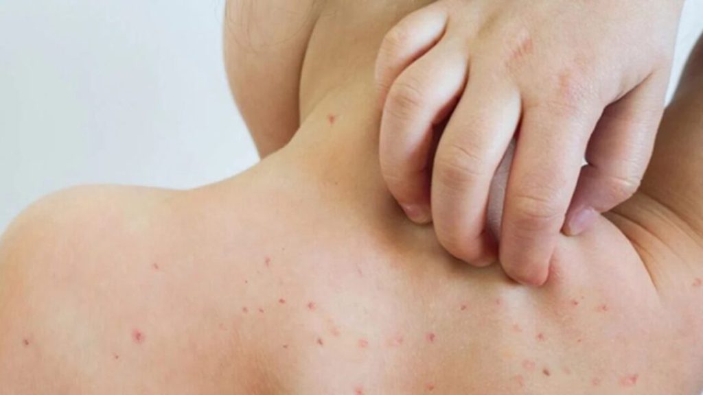 Alerta sanitaria en Atlántida por posibles casos de sarampión en La Ceiba y alrededores