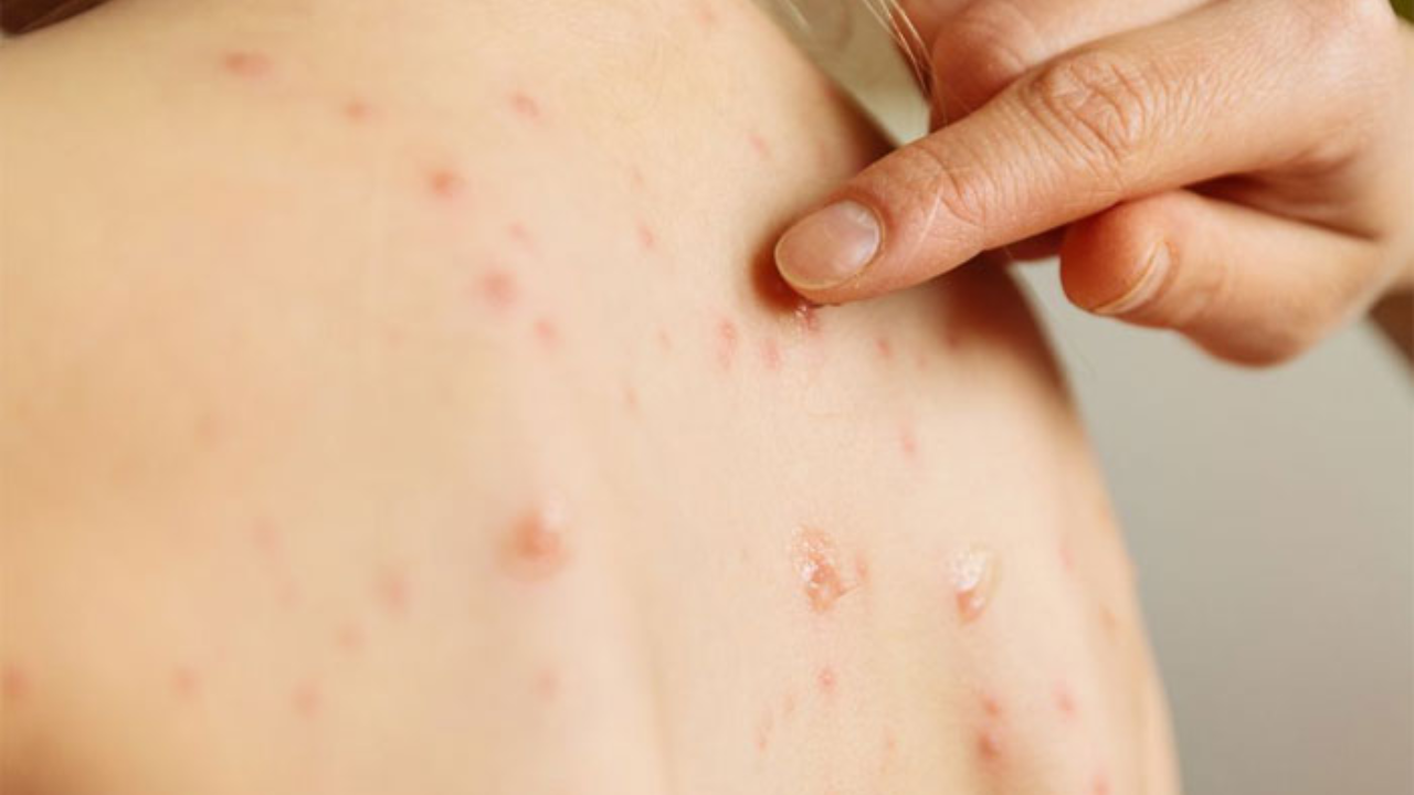 Brote de sarampión en Guatemala activa vigilancia sanitaria en Honduras